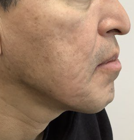 After Image: Microneedling - right-side