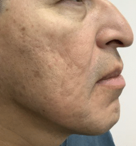Before Image: Microneedling