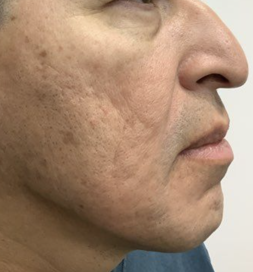Before Image: Microneedling - right-side