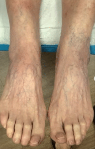 After Image: Sclerotherapy