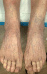 125198 c1 Patient after sclerotherapy