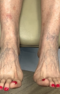 Before Image: Sclerotherapy