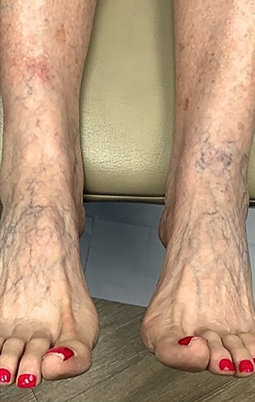 Before Image: Sclerotherapy - front