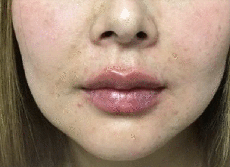 After Image: Restylane Kysse - front