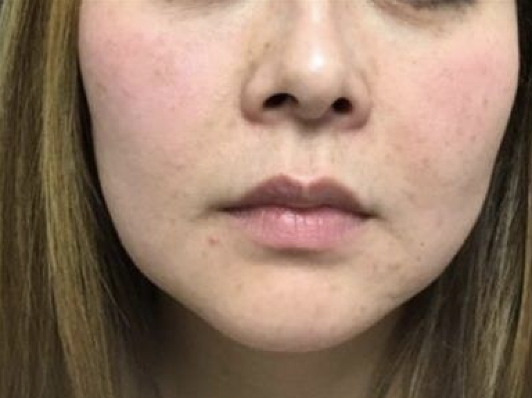 Before Image: Restylane Kysse - front
