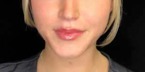After Image: Lip Filler