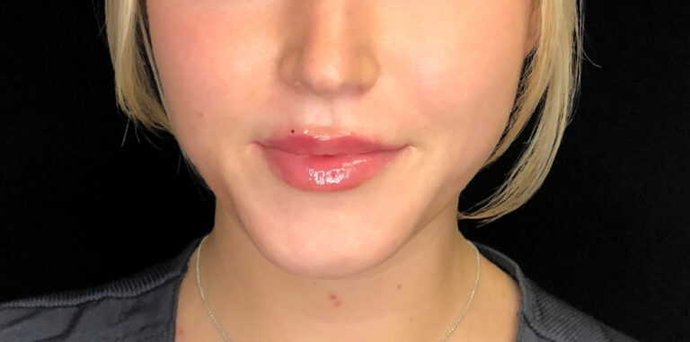 After Image: Lip Filler - front