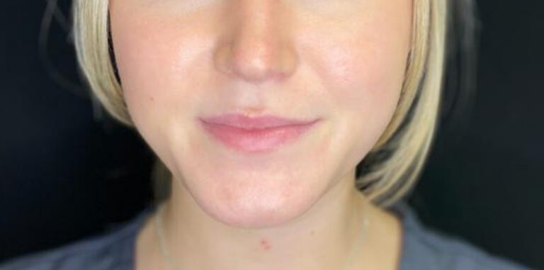 Before Image: Lip Filler - front