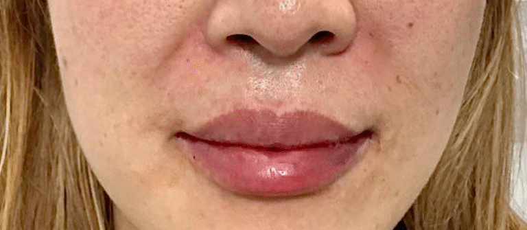 After Image: Lip Filler - front
