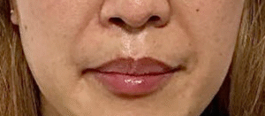 Before Image: Lip Filler