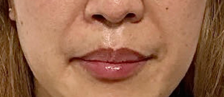 Before Image: Lip Filler - front