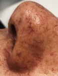 125198 c2 Rendon Sclerotherapy Before 1