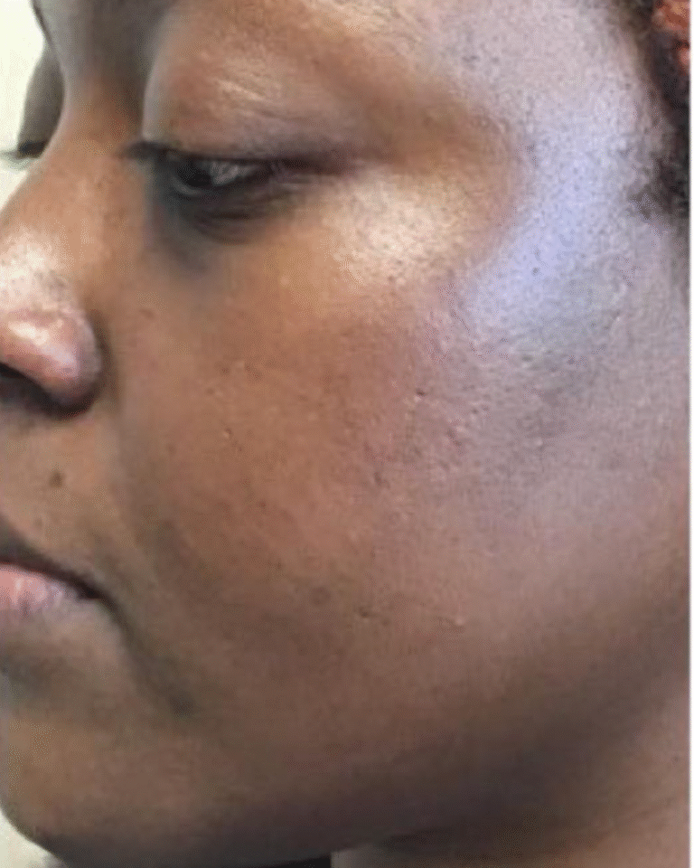 After Image: Skinpen - left-front-oblique