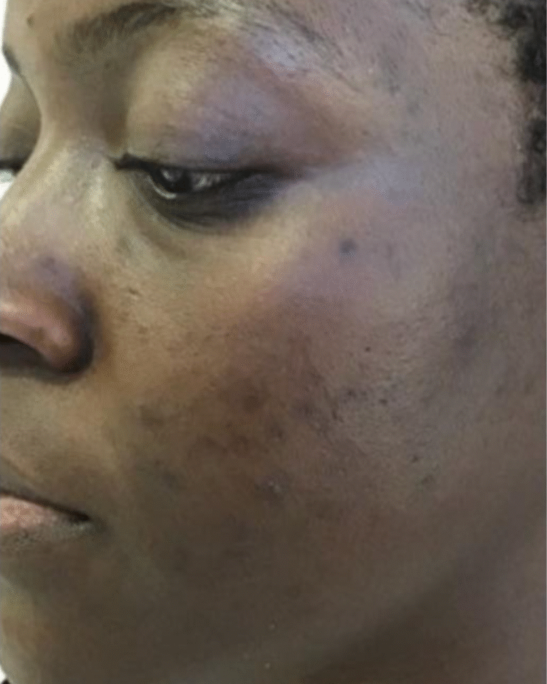 Before Image: Skinpen - left-front-oblique