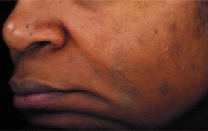 After Image: Chemical Peel