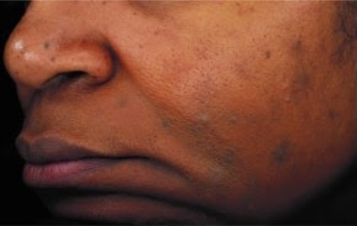 After Image: Chemical Peel - left-front-oblique