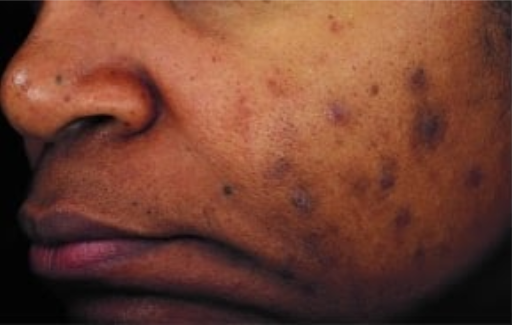 Before Image: Chemical Peel - left-front-oblique