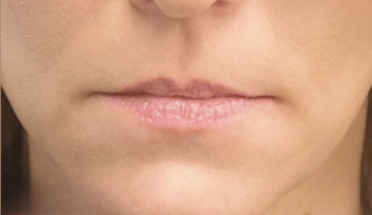Before Image: Restylane Kysse - front