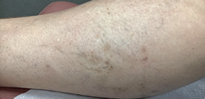 After Image: Sclerotherapy