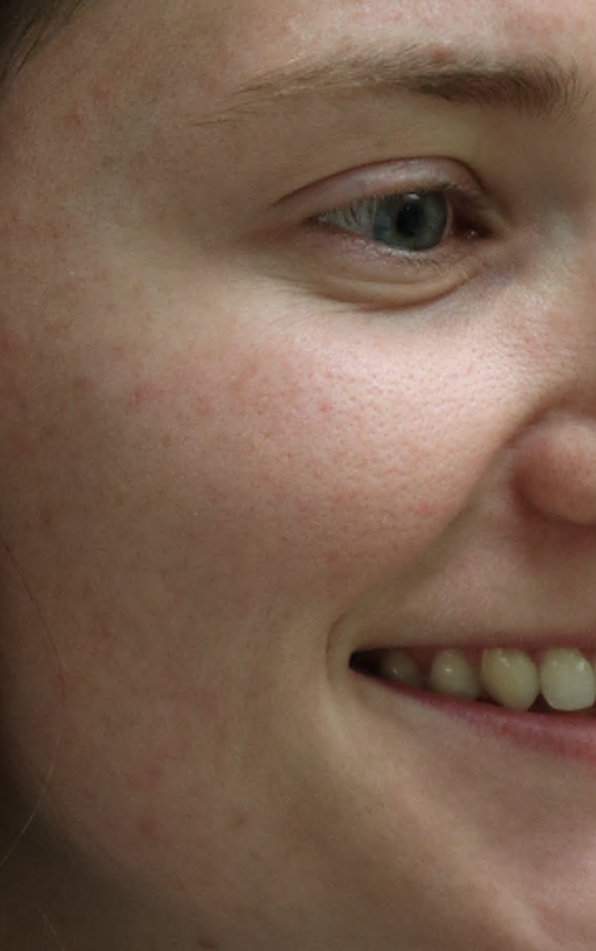 After Image: Botox - right-front-oblique