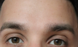 After Image: Botox