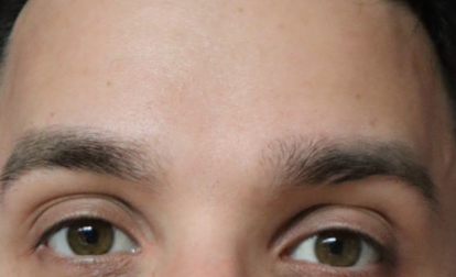 After Image: Botox - front
