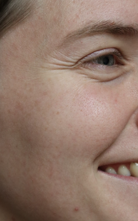 Before Image: Botox - right-front-oblique