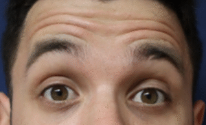Before Image: Botox