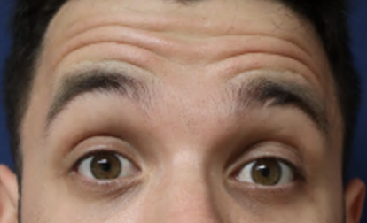 Before Image: Botox - front