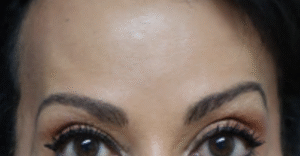 After Image: Botox