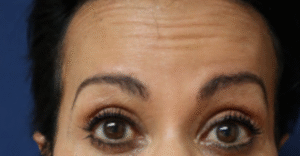 Before Image: Botox