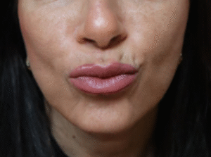 After Image: Botox Lower Face