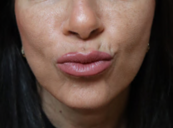 After Image: Botox Lower Face - front