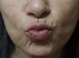Before Image: Botox Lower Face