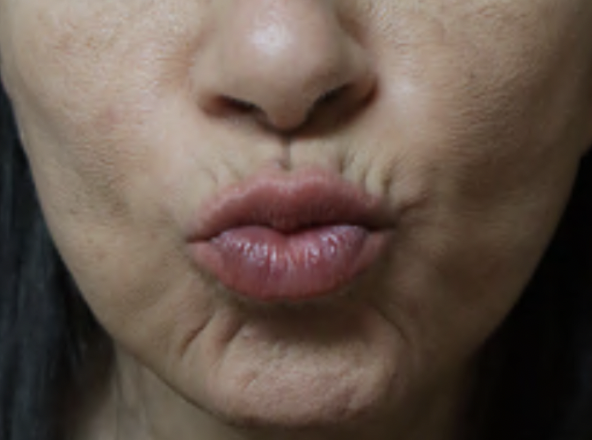 Before Image: Botox Lower Face - front