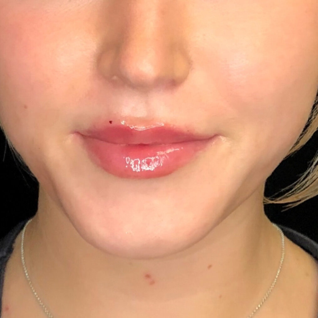 125198 c1 after lip filler
