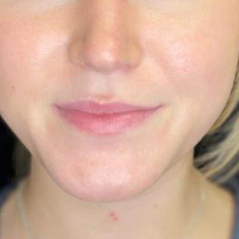 125198 c1 before lip filler
